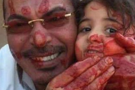 مصري ينشر صورة "دامية" له ولطفلته في عيد الأضحى