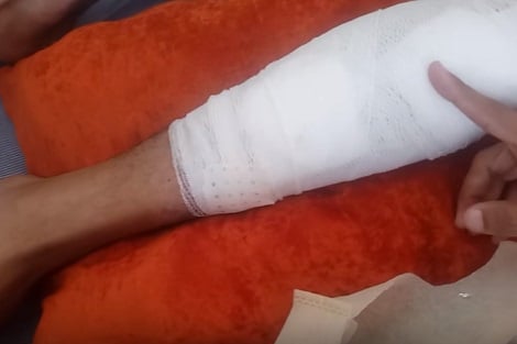قدم مهددة بالبتر