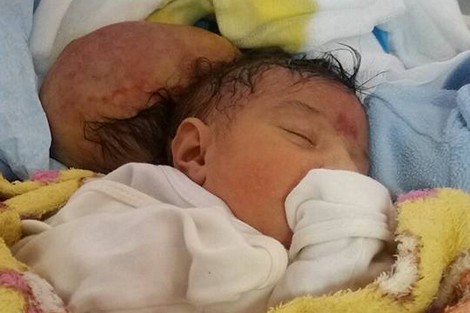فاعل خير يتكفل بعلاج الطفلة التي ولدت برأسين