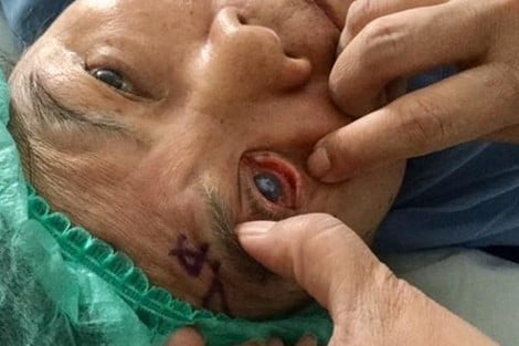 إخراج دودة بطول 15 سنتمترا من عين رجل