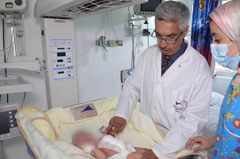 فصل توأم سيامي بالرباط