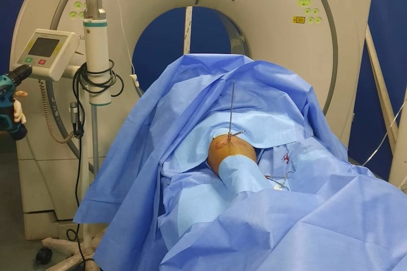 عملية نوعية تفلح في استئصال ورم نادر