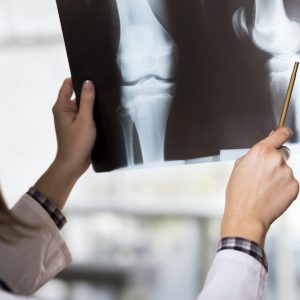 هذه العوامل ترفع خطر الإصابة بهشاشة العظام