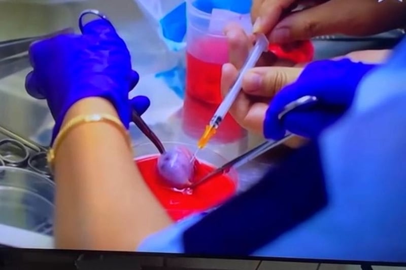 أول عملية مغربية لتجميد مبيض تحفظ خصوبة شابة تواجه سرطان الدماغ