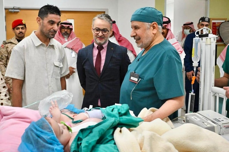 أطباء سعوديون يفصلون توأما مغربيا